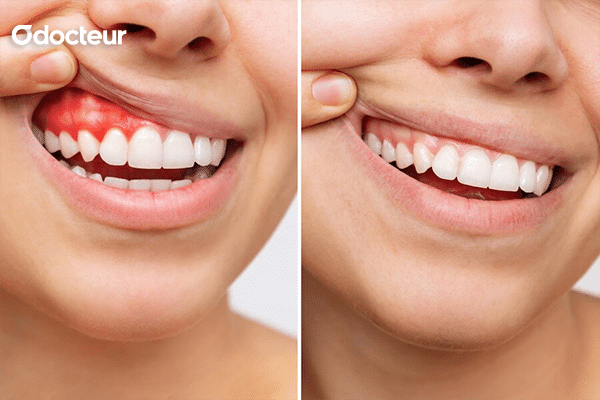 Une image illustrant visuellement la différence entre des gencives saines et des gencives affectées par le saignement, mettant en évidence l'impact du saignement des gencives sur la santé bucco-dentaire.