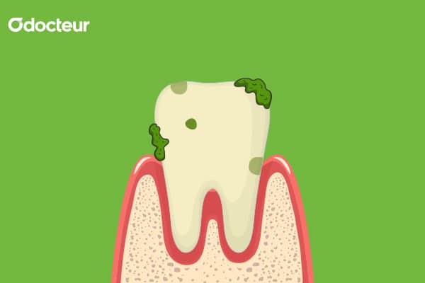 Les symptômes de la carie dentaire comprennent la douleur lors de la mastication, la sensibilité aux aliments chauds et froids et la coloration des dents. Renseignez-vous sur les signes précoces de la carie dentaire et consultez un dentiste pour obtenir des soins appropriés.